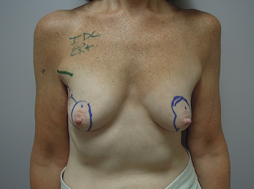 Oncoplastic Breast Cancer Surgery With Breast Lift