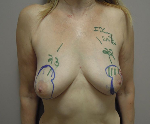 Oncoplastic Breast Cancer Surgery