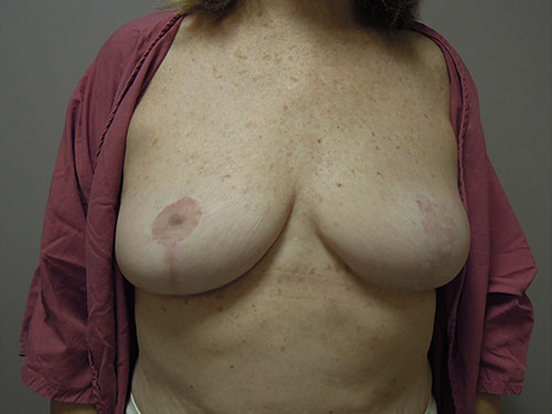 Cosmetic Revision With Removal Ruptured Implants and Mastopexy
