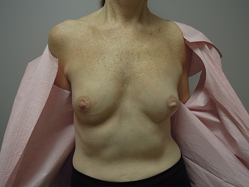 Oncoplastic Breast Cancer Surgery With Breast Lift