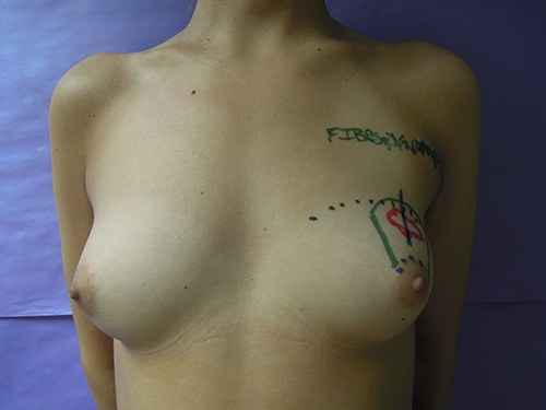 Cosmetic Breast Augmentation