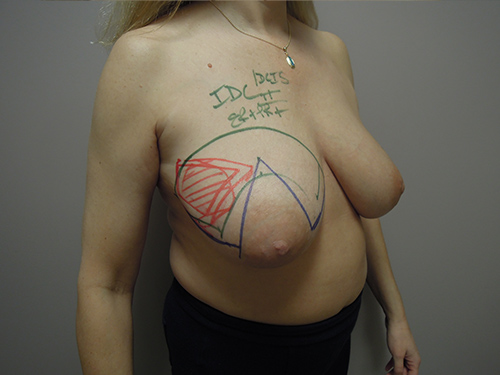 Oncoplastic Breast Cancer Surgery II